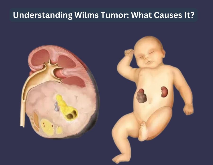 Understanding Wilms Tumor: What Causes It? | Dr. Vishesh Dikshit
